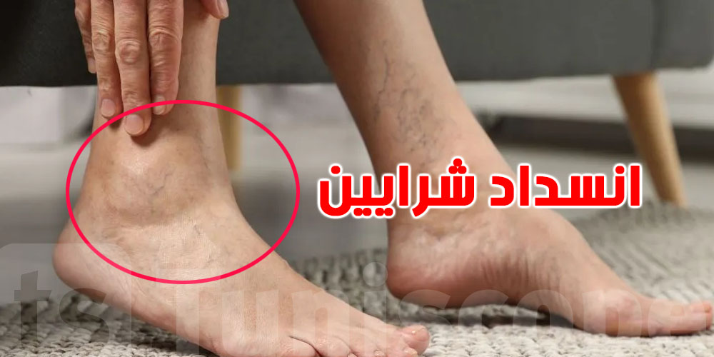 موش وجيعة عادية… 7 علامات تكشف انسداد شرايين ساقيك قبل فوات الأوان