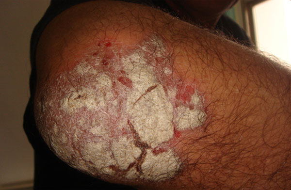 psoriasis-171015-2.jpg