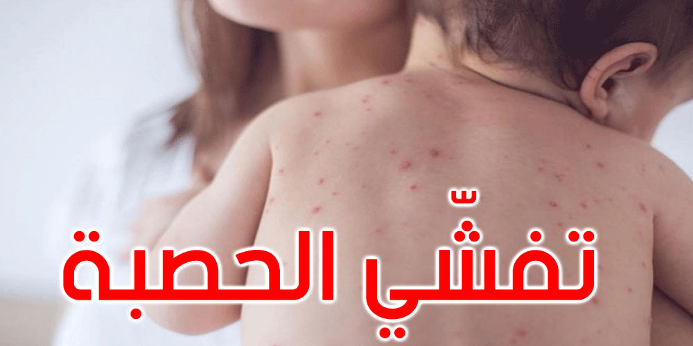 منظمة الصحة العالمية تحذّر من تفشّي مرض الحصبة