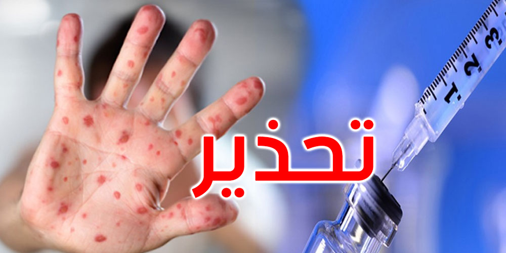 منظمة الصحة العالمية تحذر من جائحة الحصبة في العالم