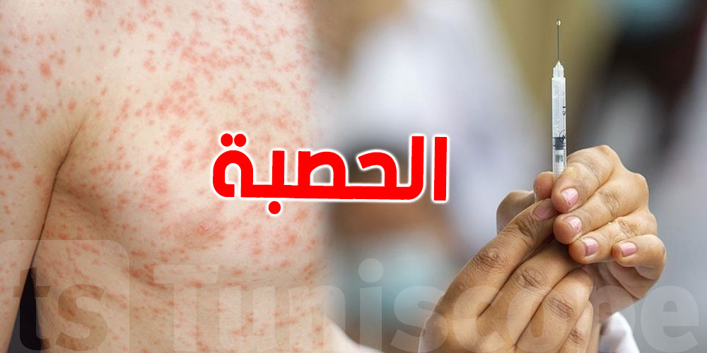 وباء الحصبة ينتشر في هذه الدولة