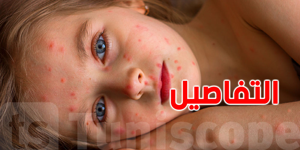 مرض قتل نصف مليار إنسان: كل ما تريد معرفته عن الجدري