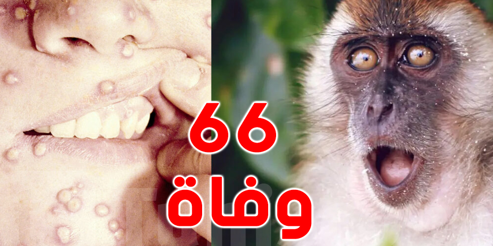  تسجيل 66 وفاة بجدري القردة