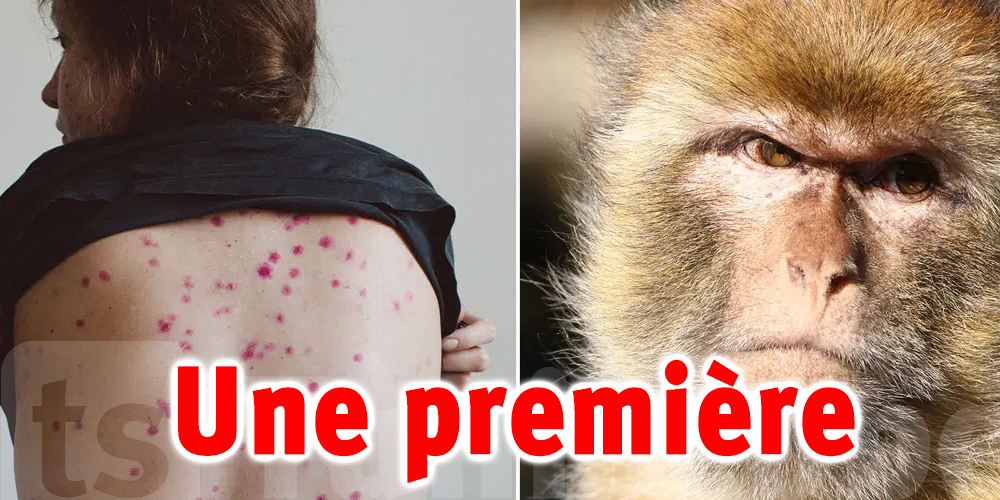 Variole du singe : une première femme infectée en...
