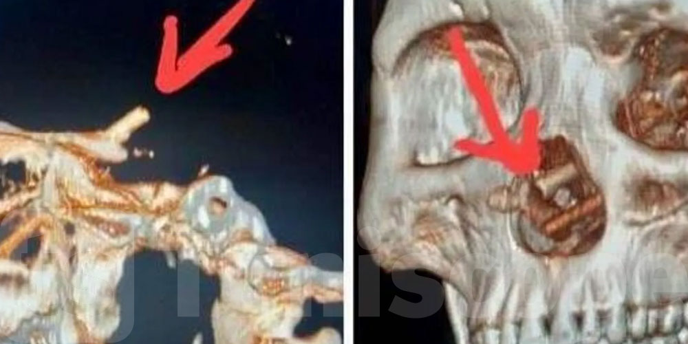 عانى من صداع وفقدان بصر.. رجل يكتشف مفاجأة داخل جمجمته