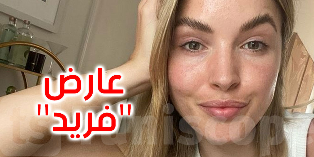 ملكة جمال الكون السابقة تكشف عن عارض ''فريد'' جراء إصابتها بفيروس كورونا