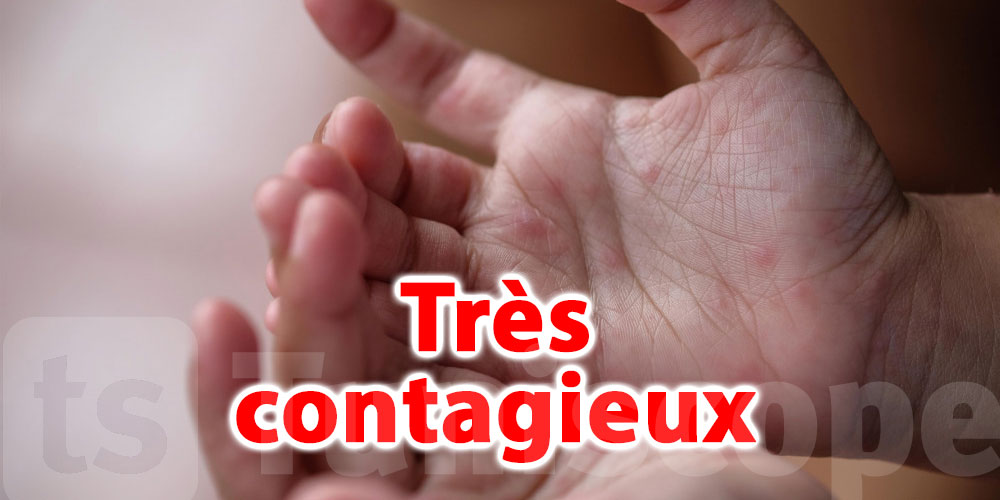 Syndrome pieds-mains-bouche, les conseils de Dr Mohamed Douagi
