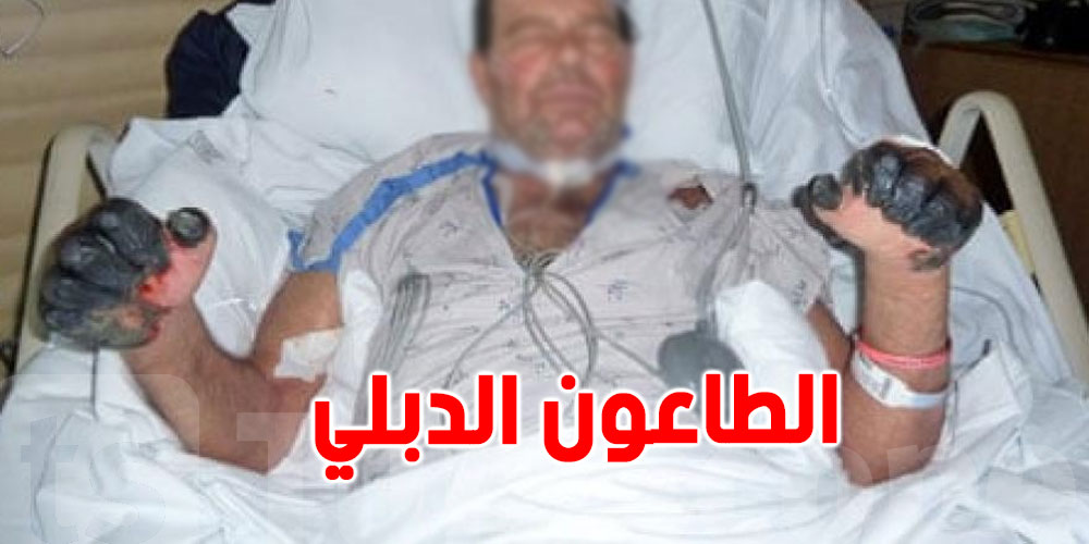 بعد تسجيل الصين إصابة بالطاعون الدبلي: ماذا قالت الصحة العالمية؟