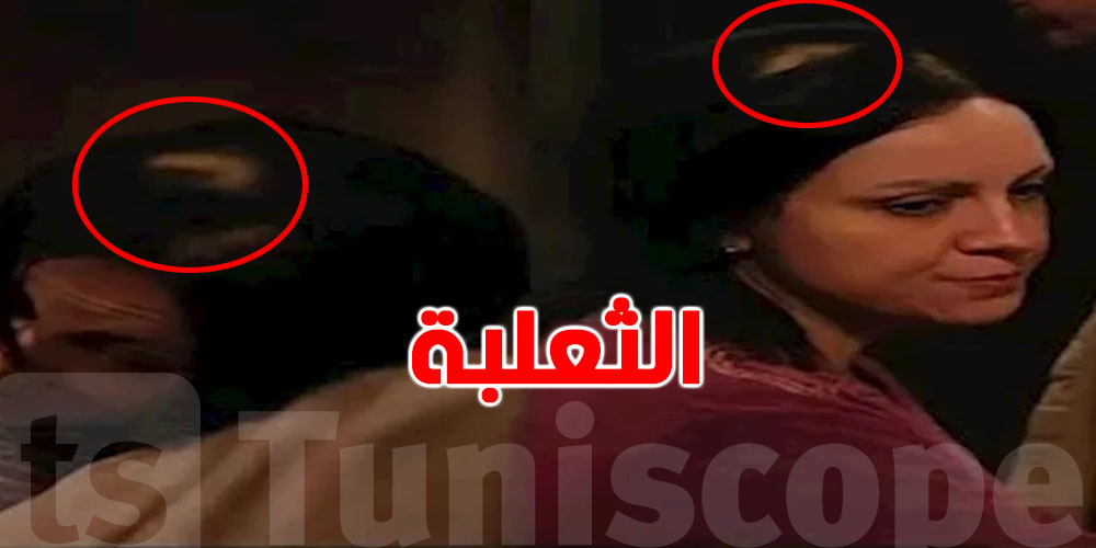 مسلسل ''حكاية نرجس'' يسلّط الضوء على الثعلبة…مرض مناعي يسبب تساقط الشعر