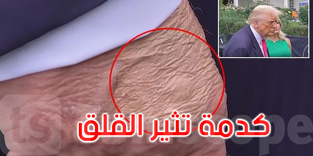 كدمات على يد ترامب.. البيت الأبيض يكشف السبب ويكشف الحالة الصحية للرئيس