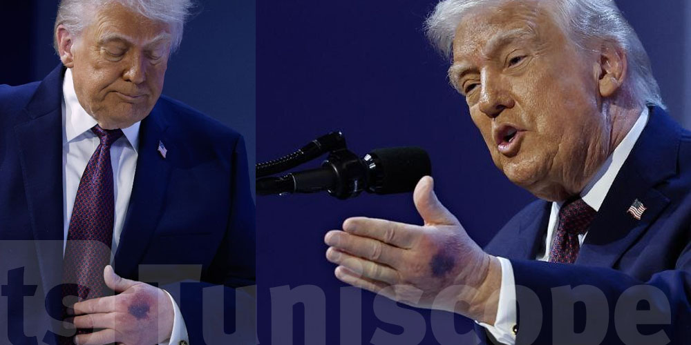 عاجل : ترامب يتعرض لإصابة ...البيت الابيض يكشف التفاصيل