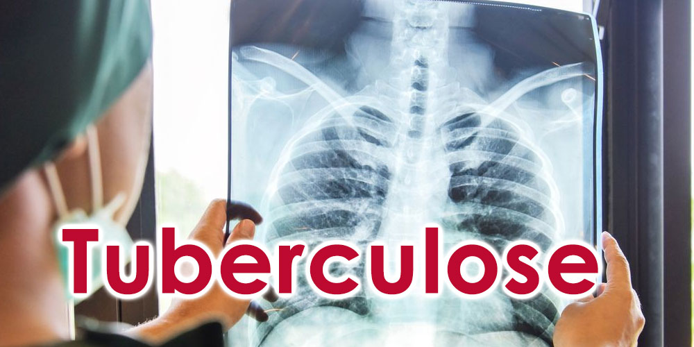 Tuberculose en Tunisie : 80 % des 1 500 cas annuels d’origine animale
