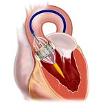 Réussite médicale : une valve aortique implantée sans chirurgie à Sfax