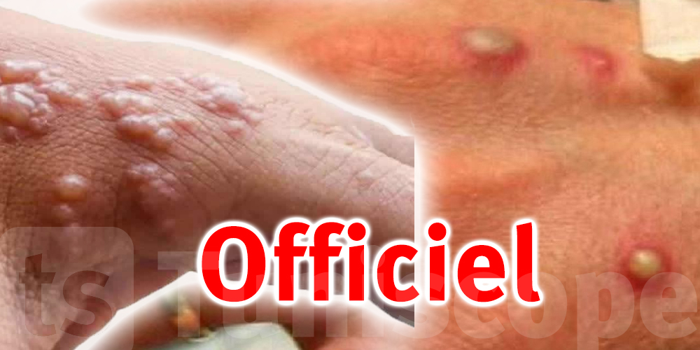 Officiel :Aucun cas de variole du singe signalé en Tunisie