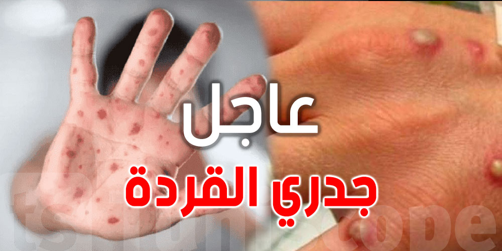 بشرى بخصوص جدري القردة في العالم