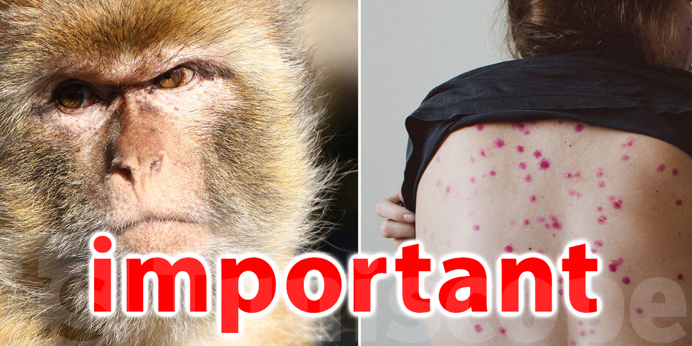 Variole du singe : Urgent : premier cas dans un pays très visité par les Tunisiens