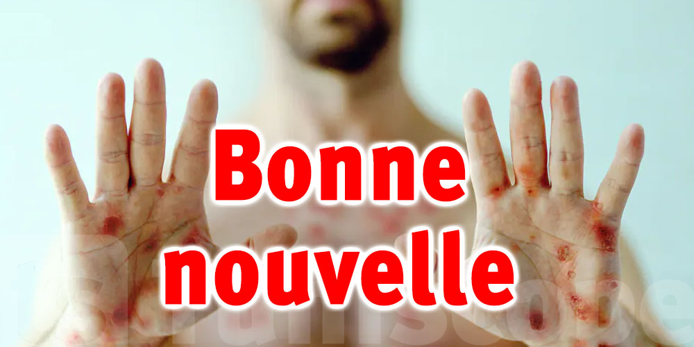 Variole du singe : Bonne nouvelle