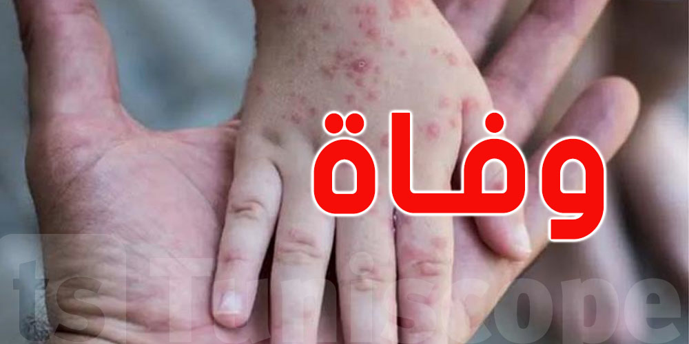 إسبانيا تُسجّل أوّل وفاة بجدري القردة