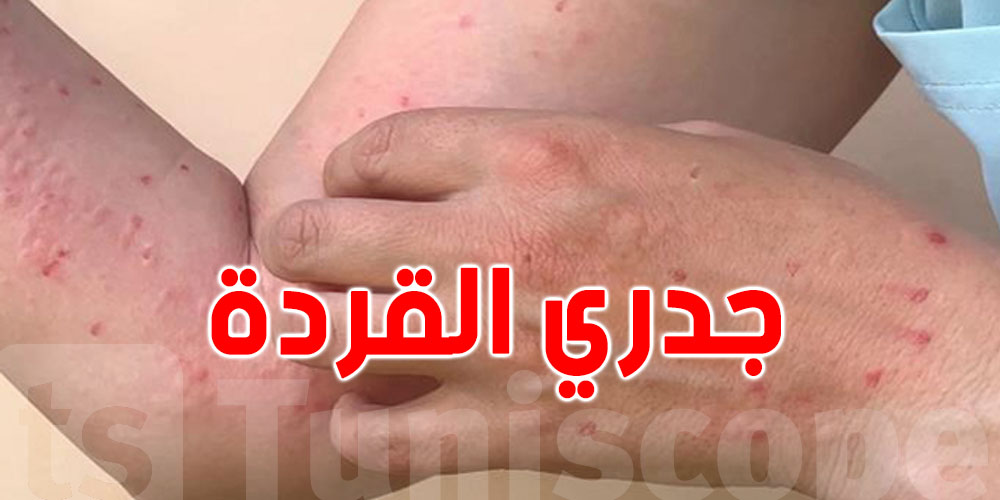 نيويورك تسجل أول إصابة بالسلالة الأخطر من فيروس جدري القردة