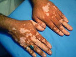 Un traitement contre le Vitiligo 100% tunisien