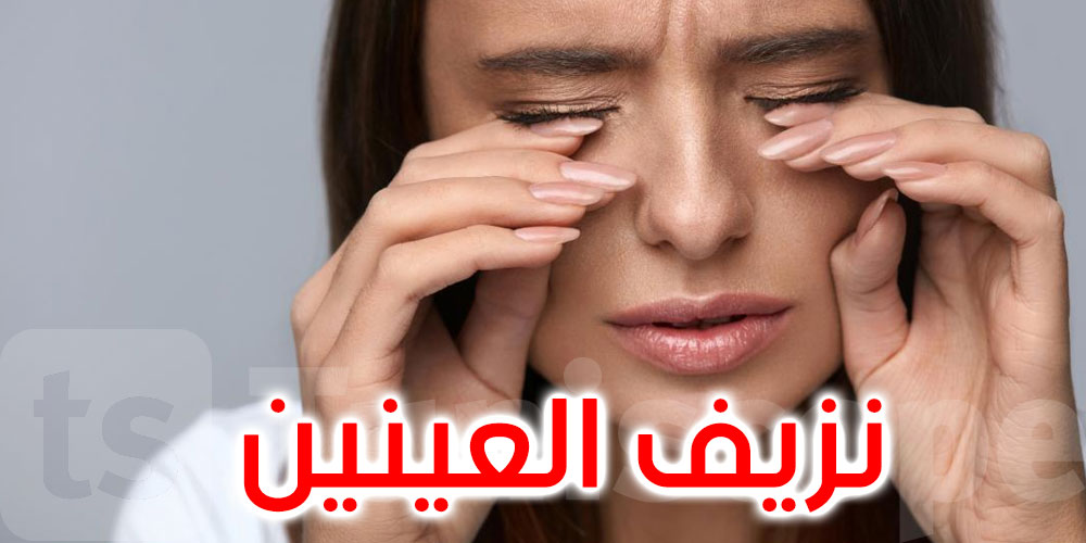 تسبب نزيف العينين.. هذا البلد يسجل إصابة بـ''حمى نادرة''
